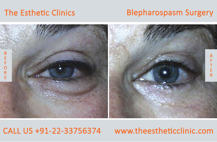Blepharospasm Treatment, Eyelid Treatment before after photos in mumbai india (6)
